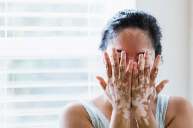 Mulher mostrando as mãos com vitiligo 